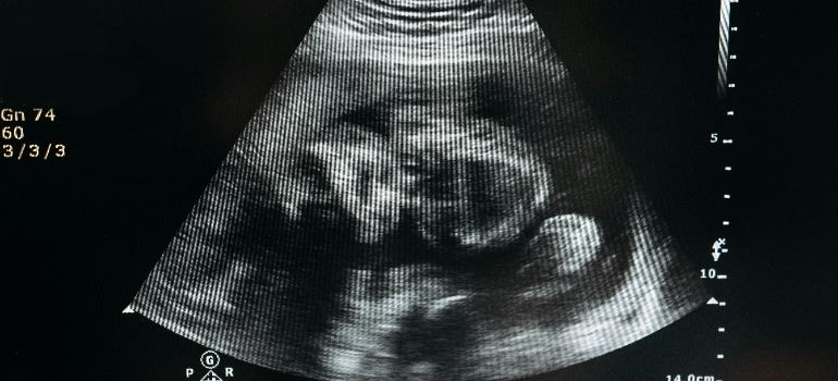 an ultrasound image of a baby