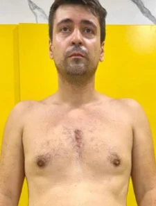 Weight Loss: 6kg — before